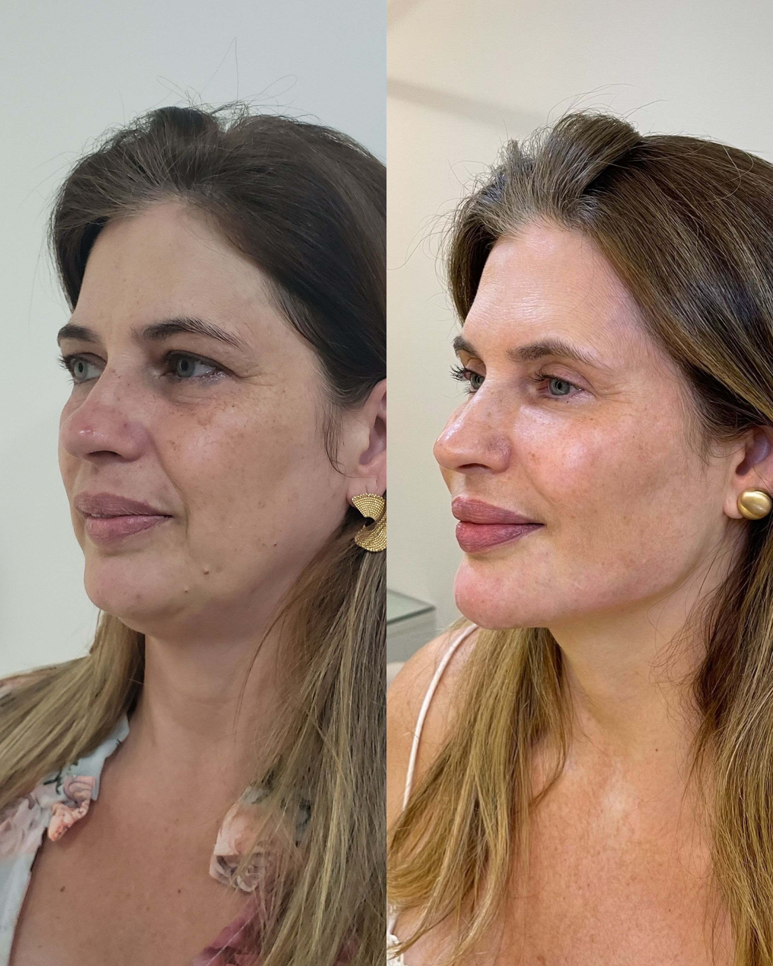 Antes e depois — Método Manzini · Caso 06